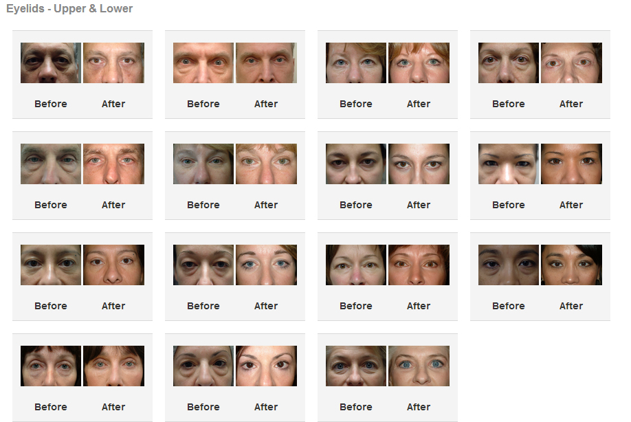 Eyelid Surgery (Blepharoplasty) Before and After Photos Dr. Jabs, Dr. Richards
