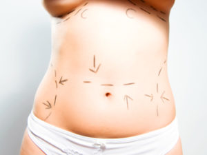 Abdominoplasty Recovery Time In Northern Virginia