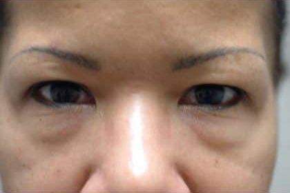 7000 Before Image