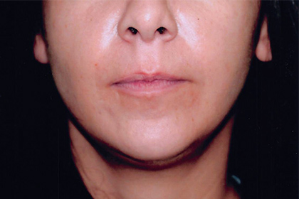 Buccal Fat Pad Removal Bethesda  Buccal Fat Pad Removal in Maryland