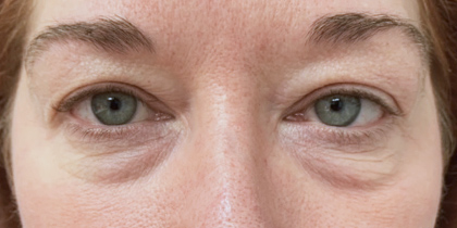 Case 3702 Before Image