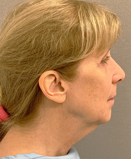 9876-10 Before Image