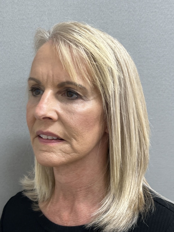 Patient #9259 After Image