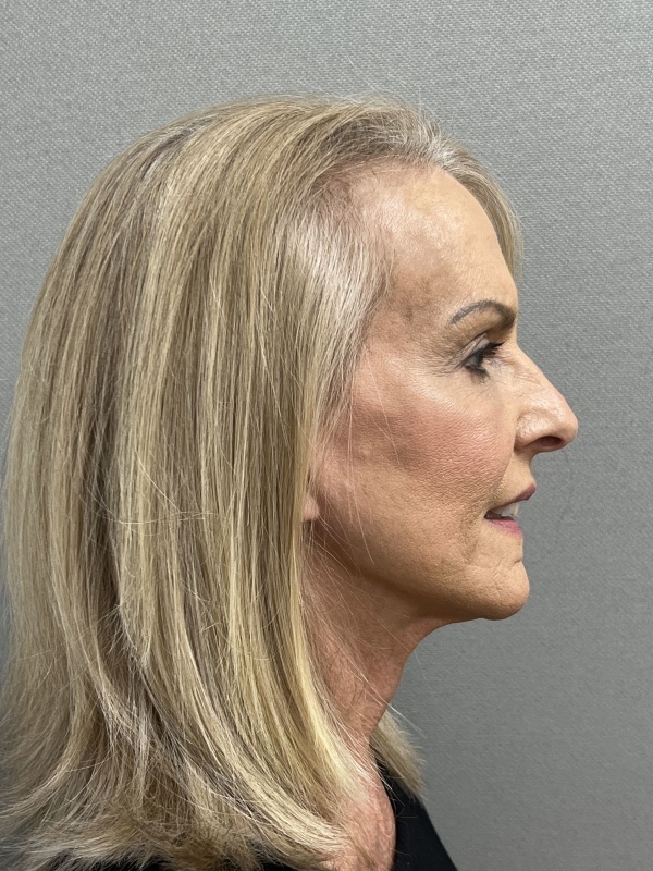 Patient #9259 After Image