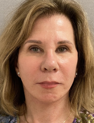 91111-20 After Image