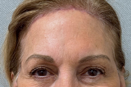 2044-20 After Image