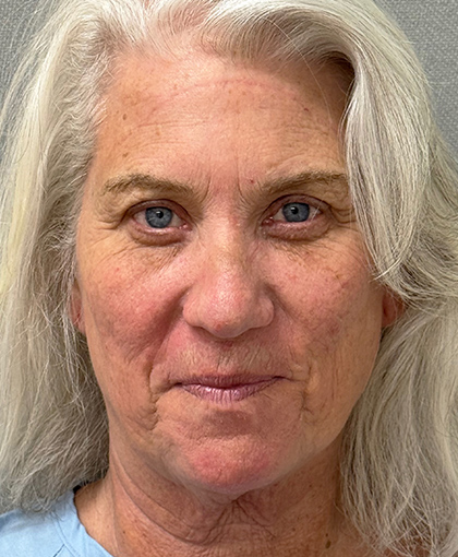 1100-20 Before Image