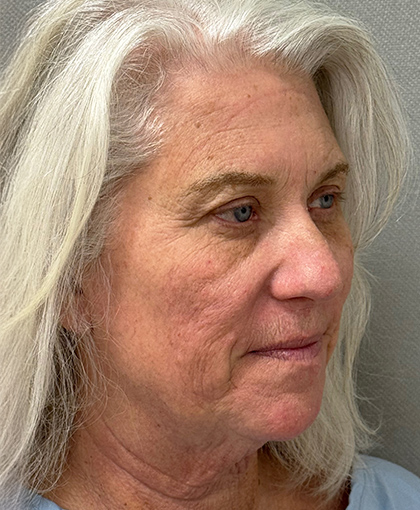 1100-20 Before Image