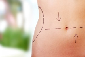 Liposuction Surgery Weight Loss Northern Virginia | McLean | Fairfax VA
